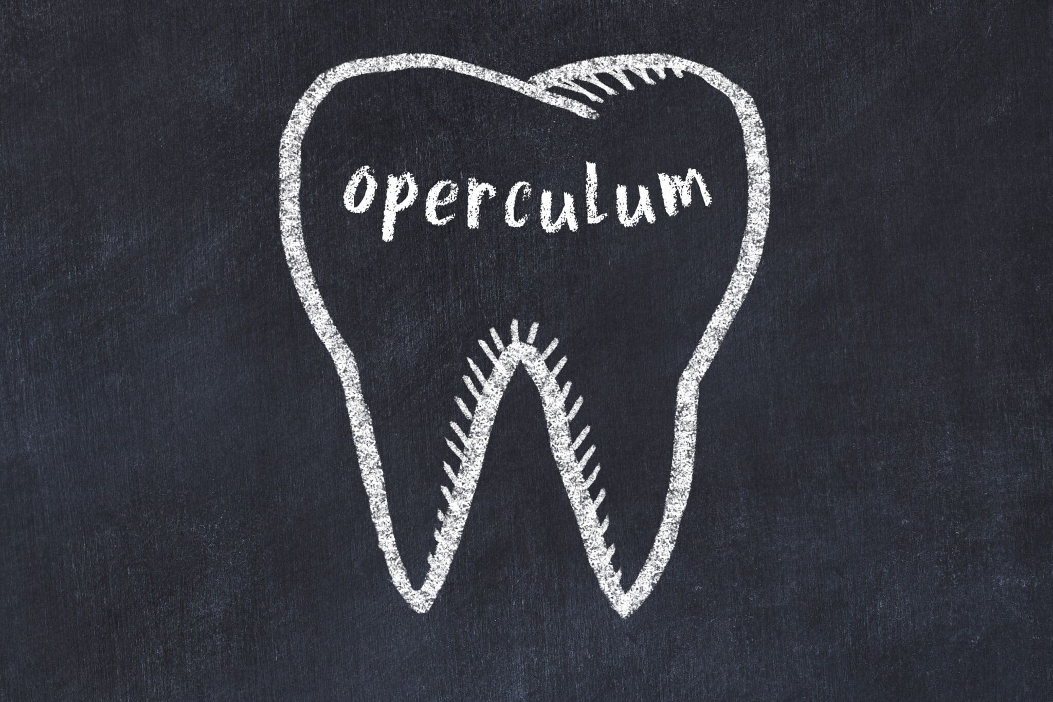 What is a Dental Operculum and Do You Have It?