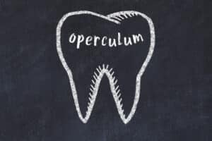 What is Dental Operculum and Do You Have It